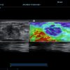 dc-70_Natural-Touch-Elastography-of-breast-mass